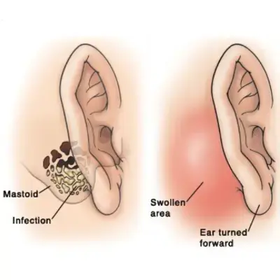 Mastoid Surgery | Dhanani's ENT Clinic