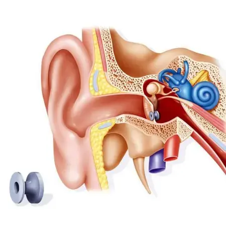 Myringotomy Surgery Hospital in Bhuj, Kutch | Dhanani's ENT Clinic