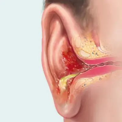 Ear Infection | Dhanani's ENT Clinic