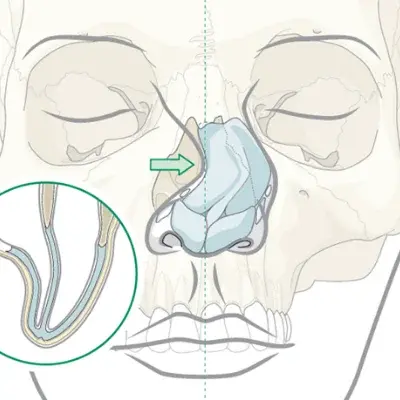 Nasal Fractures | Dhanani's ENT Clinic