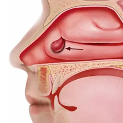 Nasal Polyps | Dhanani's ENT Clinic