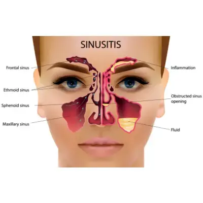 Sinusitis (Sinus Infection) | Dhanani's ENT Clinic